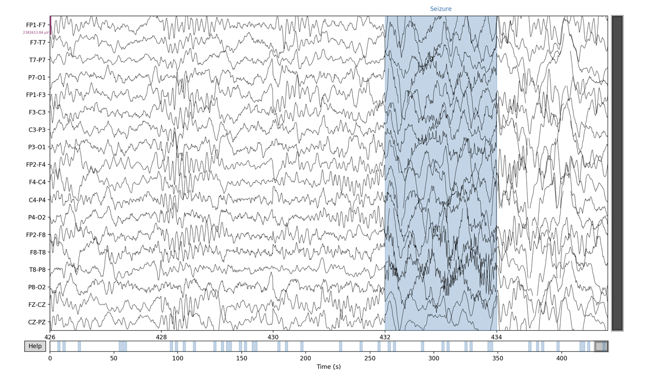 Deep Learning based multi-resolution seizure detection using multi-channel EEG